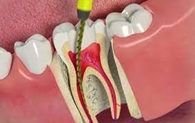 Root Canal Treatment Clinic