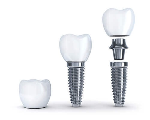 Dental Implants Clinic
