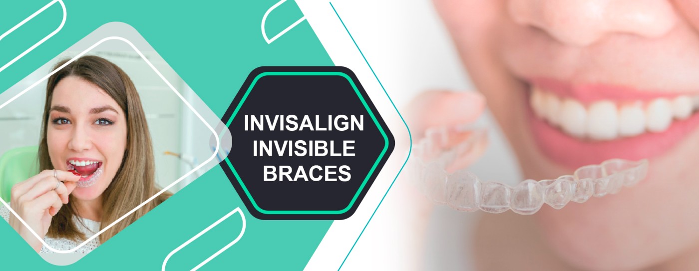Best Invisalign Invisible Braces Treatment