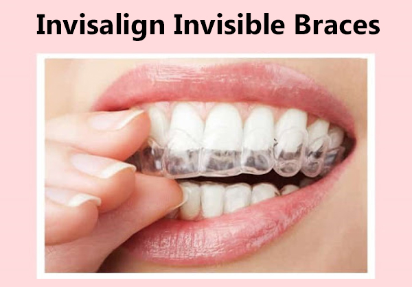 Best Invisalign Invisible Braces Treatment
