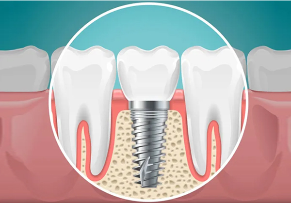 Best Dental Implants Clinic 