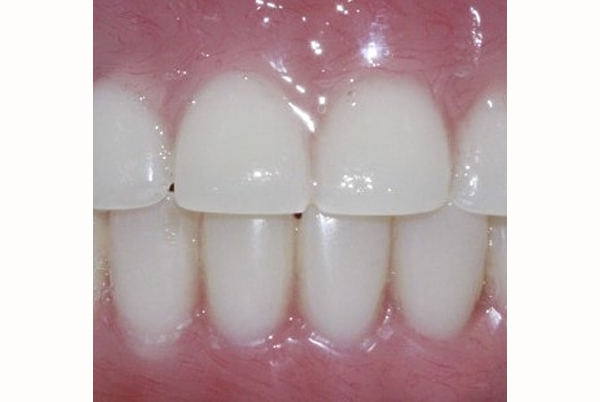 Best Teeth Whitening 