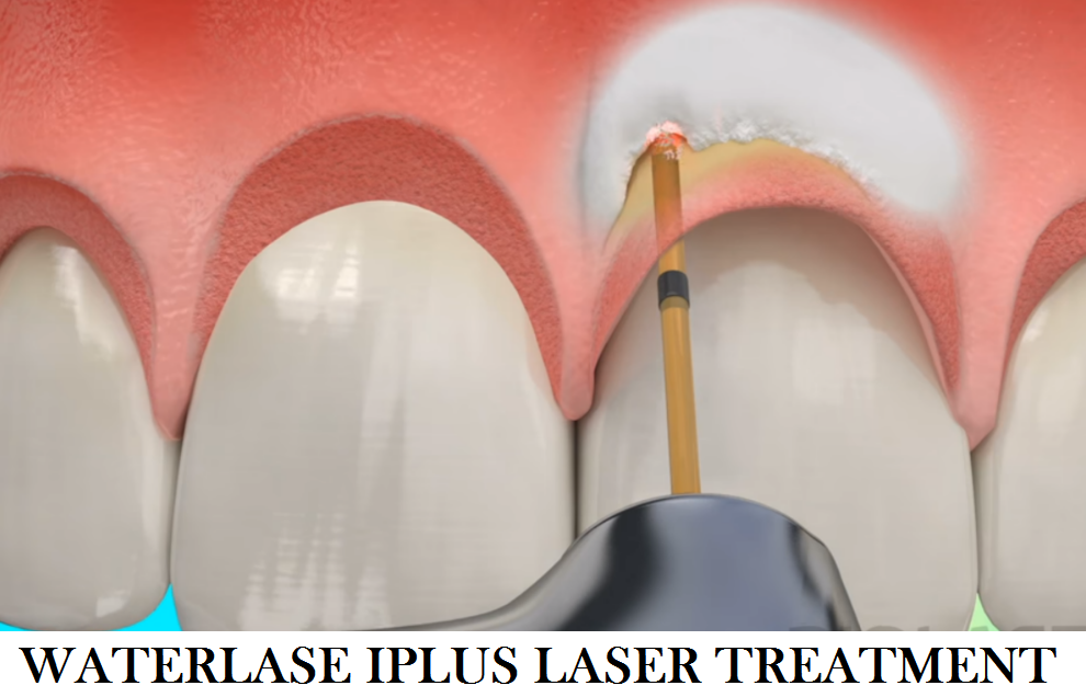 Best Waterlase Iplus Laser Treatment